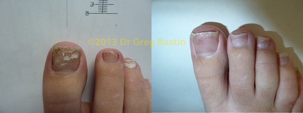 Best Toenail Fungus Cure
