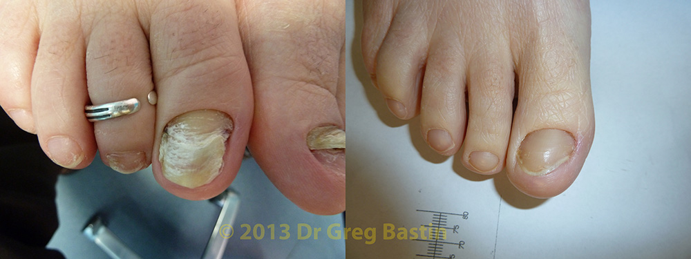 Athlete's Foot (Fungal Nail Infection) - Procare Podiatric Medicine &  Surgery