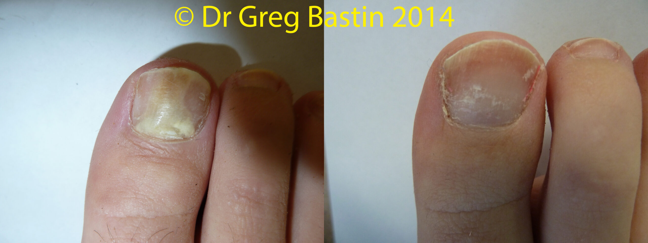 Treatment for Fungal Nails