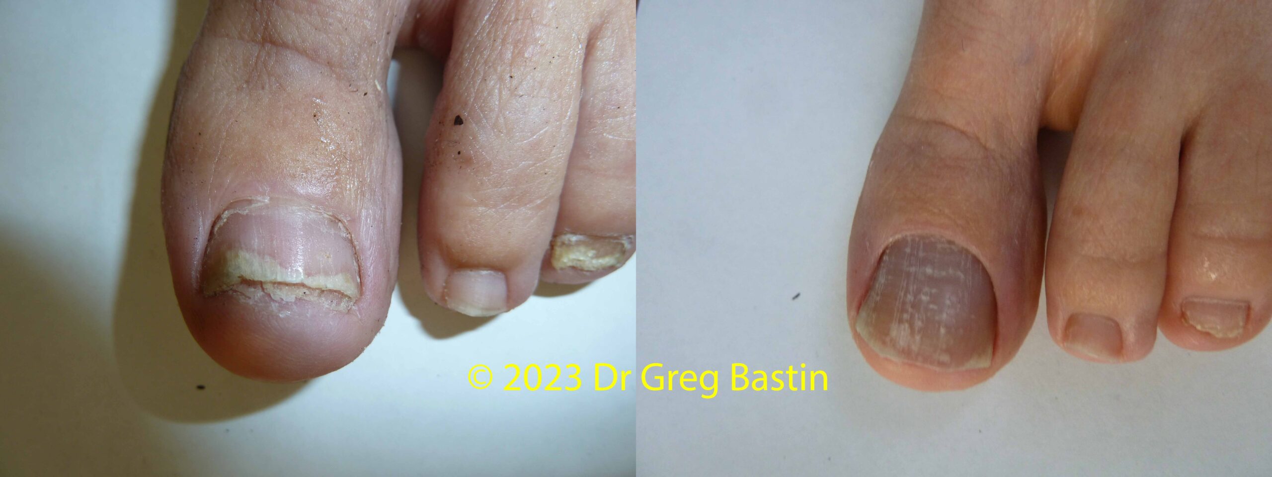 Toenail Fungus Laser Treatment St Ives, Barangaroo, Bondi Junction