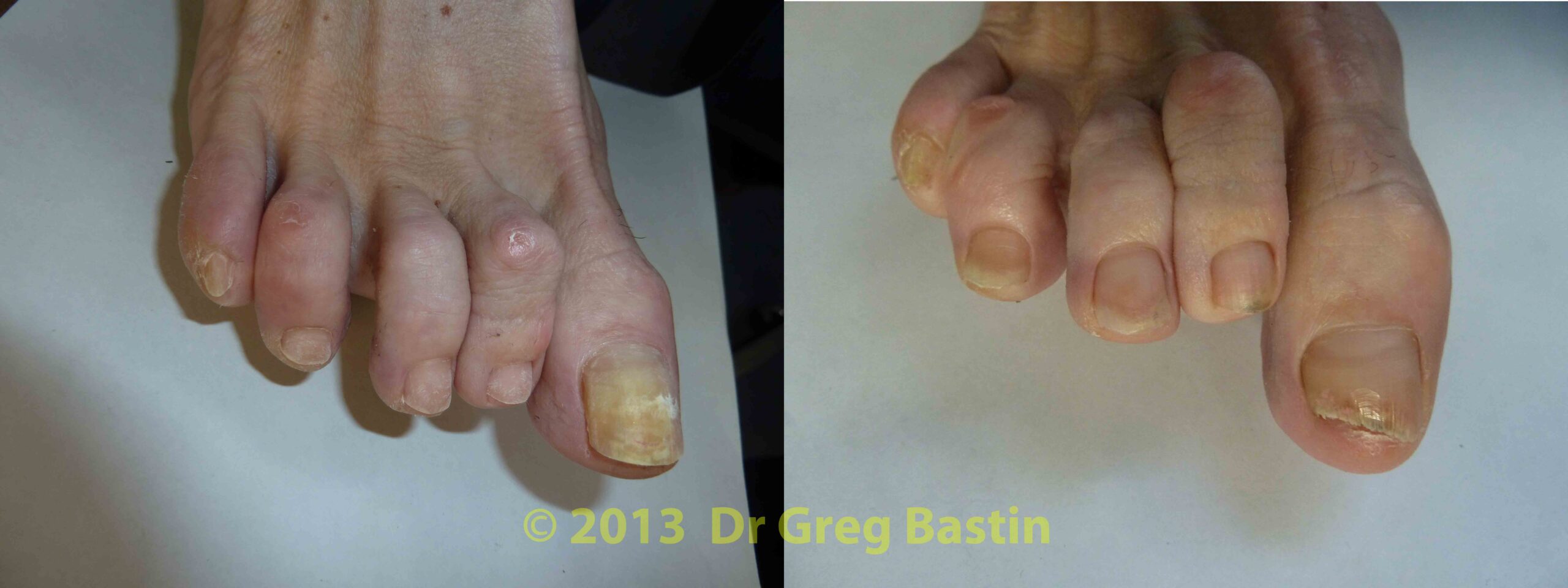 Hammer Toe Correction & Plantar Plate Repair - Dr Greg Sterling