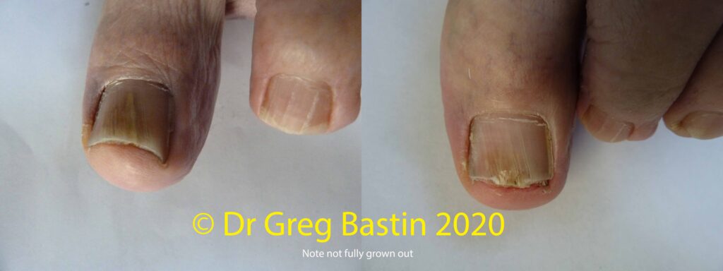 Laser Treatment of Nail Fungus