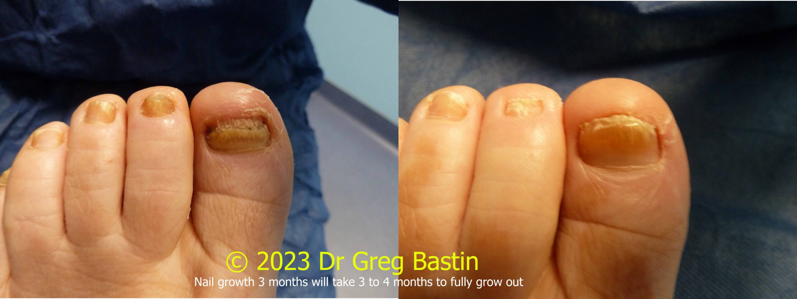 Best laser for toenail fungus