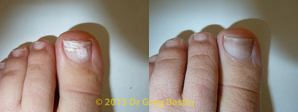 cold laser nail fungus melbourne