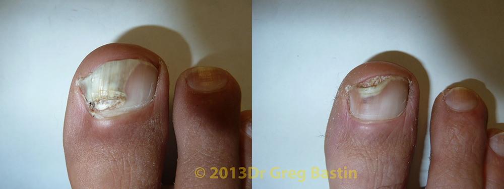 fungal nail specialist melbourne